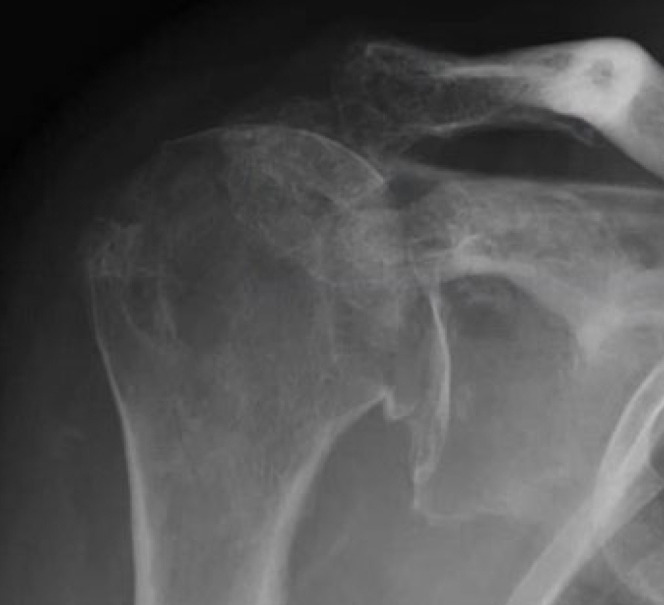 Chronic locked anterior shoulder dislocation with impaction of the humeral head onto the coracoid: a case report.