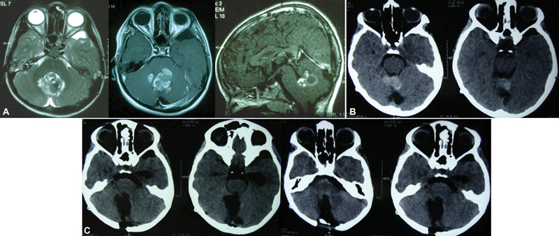 Cystic Cerebral Cavernous Malformations: Report of Five Cases and a Review of Literature.