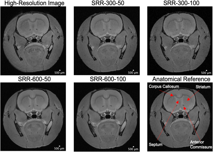 Super-resolution reconstruction in ultrahigh-field MRI.