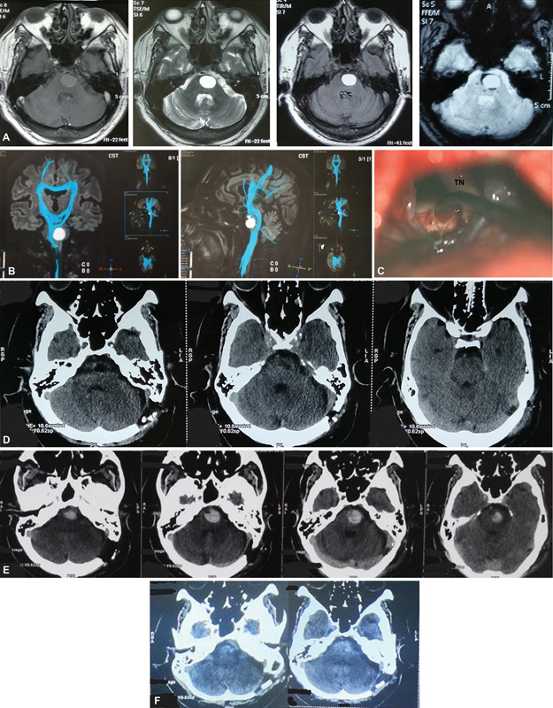 Cystic Cerebral Cavernous Malformations: Report of Five Cases and a Review of Literature.