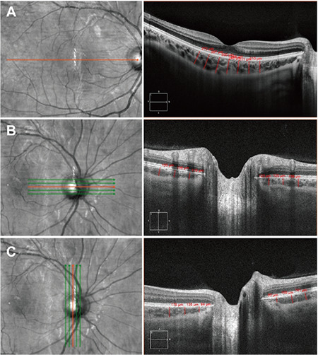 Clinical Relevance of Choroidal Thickness in Obese and Healthy Children: A Machine Learning Study.