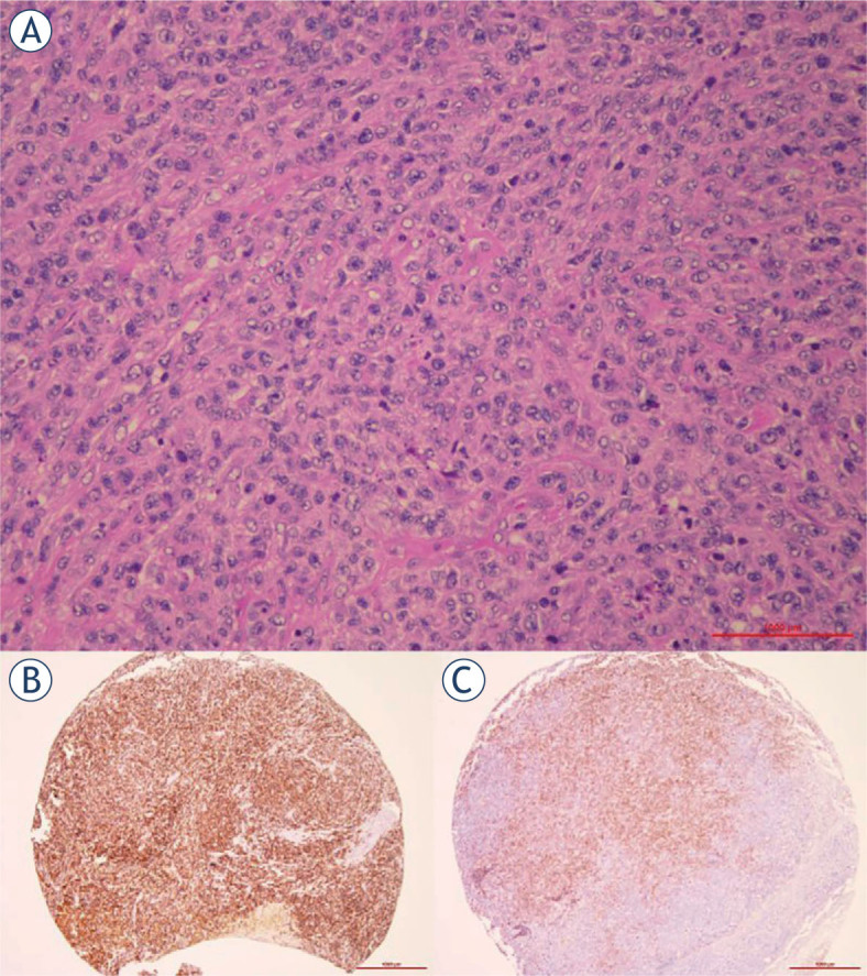 CD56-positive diffuse large B-cell lymphoma: comprehensive analysis of clinical, pathological, and molecular characteristics with literature review.