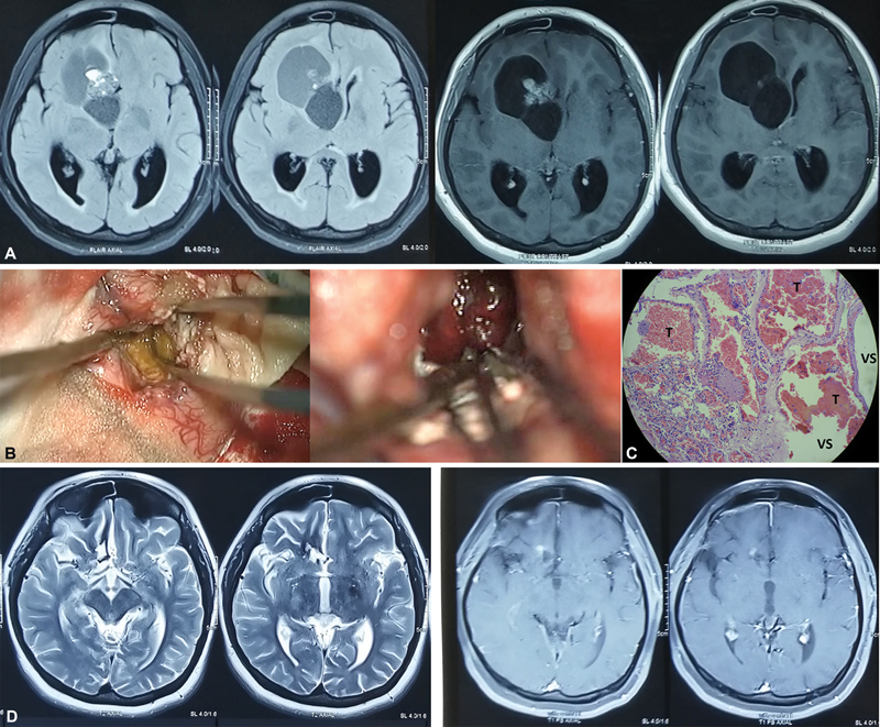 Cystic Cerebral Cavernous Malformations: Report of Five Cases and a Review of Literature.