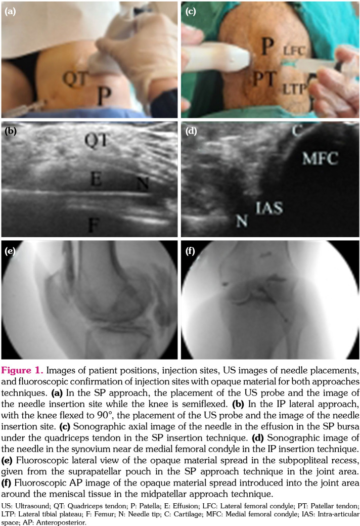 Comparison of radiological and clinical results of knee intra-articular injections with two ultrasonography-guided approach techniques: A randomized controlled study.