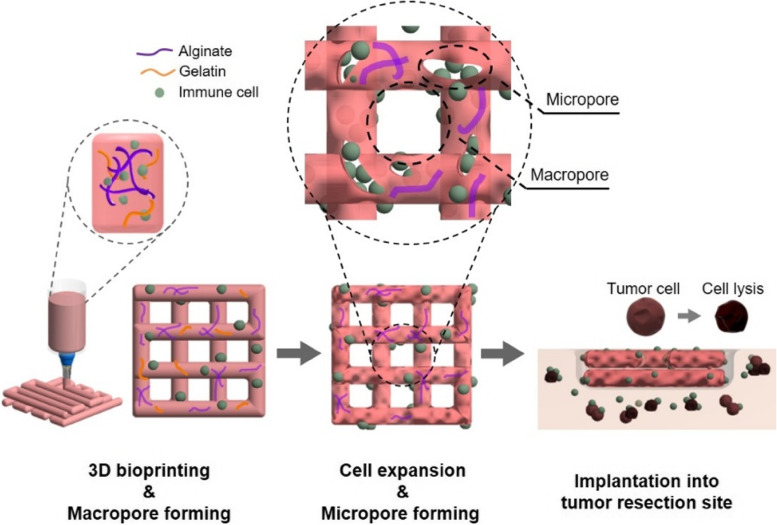 NK cells encapsulated in micro/macropore-forming hydrogels via 3D bioprinting for tumor immunotherapy.