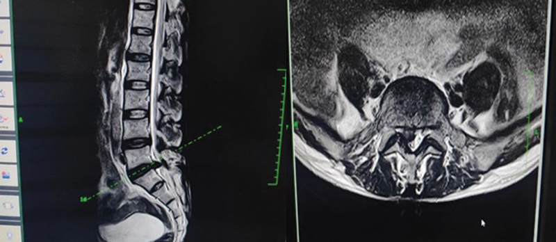 Outcome of Transforaminal Endoscopic Discectomy in Rural India in a Single-Level Lumbar Disc Prolapse Under Local Anesthesia.