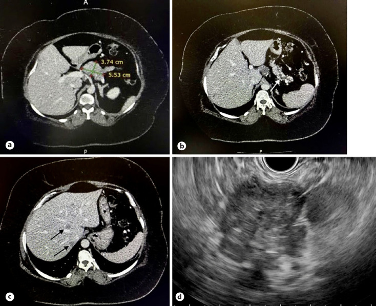 A Rare Case of Ectopic Adrenocorticotropic Hormone Secretion from Pancreatic Neuroendocrine Tumour Presenting with Cushing Syndrome.