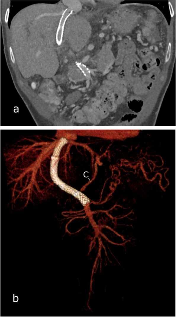 Portal Vein Recanalization-Transjugular Intrahepatic Portosystemic Shunt (PVR-TIPS) with superior mesenteric vein access and balloon-assisted shunt placement.