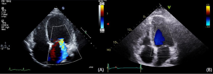 Combination therapy of liothyronine and levothyroxine for hypothyroidism-induced dilated cardiomyopathy.