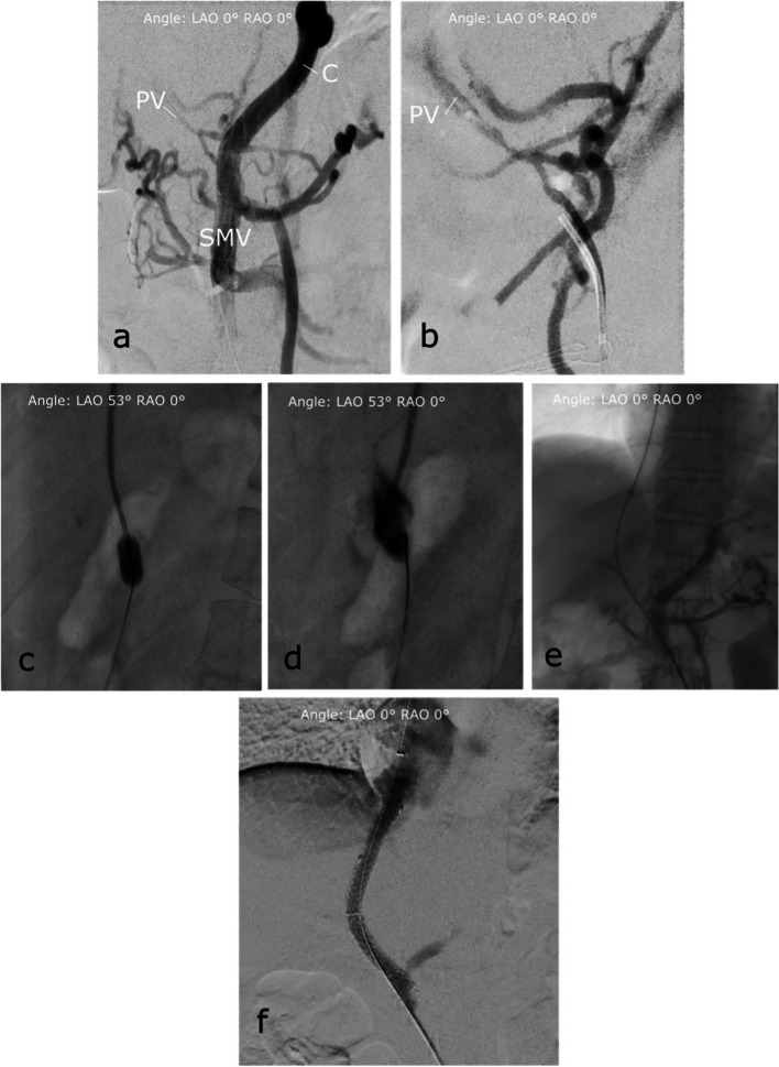 Portal Vein Recanalization-Transjugular Intrahepatic Portosystemic Shunt (PVR-TIPS) with superior mesenteric vein access and balloon-assisted shunt placement.