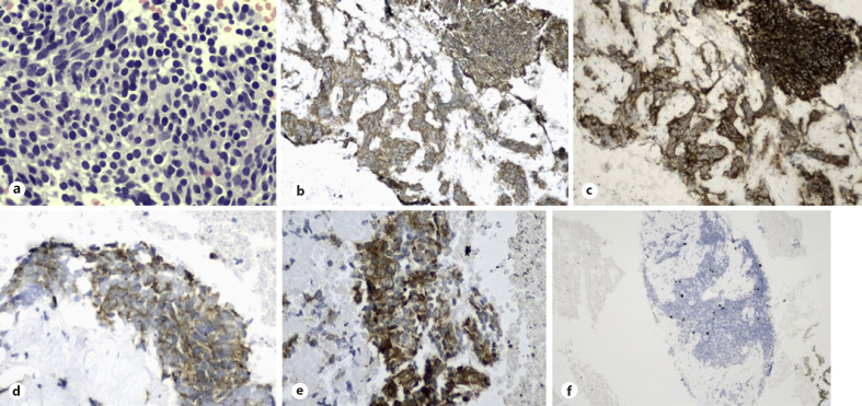 A Rare Case of Ectopic Adrenocorticotropic Hormone Secretion from Pancreatic Neuroendocrine Tumour Presenting with Cushing Syndrome.