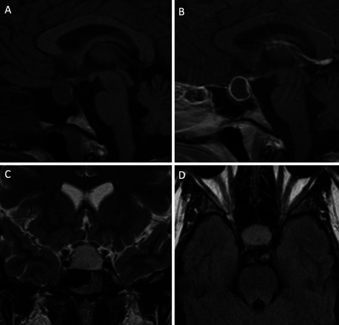 Rathke's cleft cyst presenting with recurrent aseptic meningitis and inflammatory apoplexy: illustrative case.
