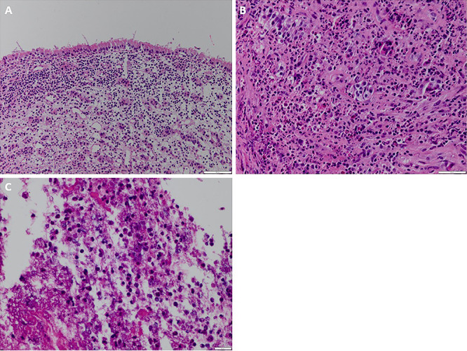 Rathke's cleft cyst presenting with recurrent aseptic meningitis and inflammatory apoplexy: illustrative case.