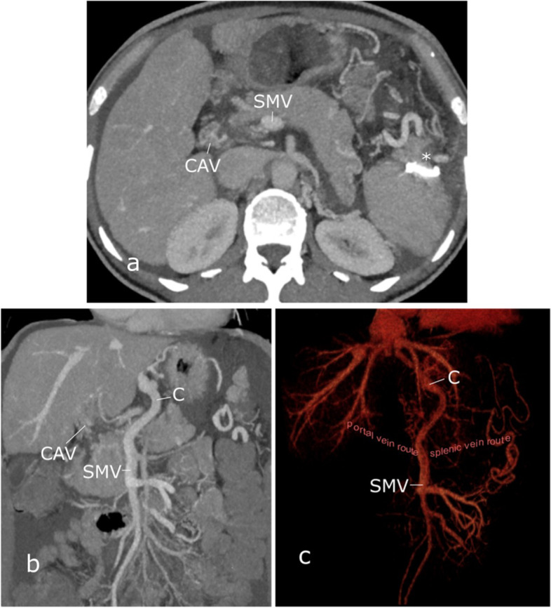 Portal Vein Recanalization-Transjugular Intrahepatic Portosystemic Shunt (PVR-TIPS) with superior mesenteric vein access and balloon-assisted shunt placement.