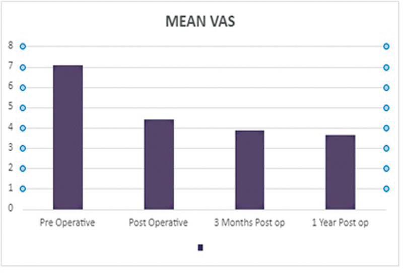 Outcome of Transforaminal Endoscopic Discectomy in Rural India in a Single-Level Lumbar Disc Prolapse Under Local Anesthesia.