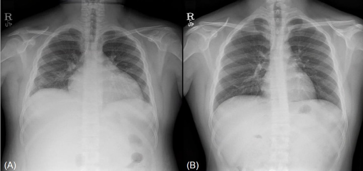 Combination therapy of liothyronine and levothyroxine for hypothyroidism-induced dilated cardiomyopathy.