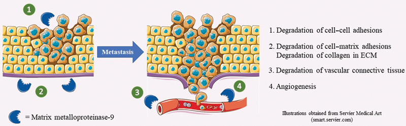 The Role of the <i>Matrix Metalloproteinase-9</i> Gene in Tumor Development and Metastasis: A Narrative Review.