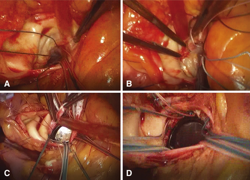 Aortic Valve Replacement by Subannular Endomyocardial Implantation of Valve Prosthesis in Behçet's Disease.