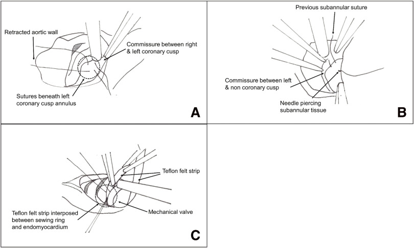 Aortic Valve Replacement by Subannular Endomyocardial Implantation of Valve Prosthesis in Behçet's Disease.