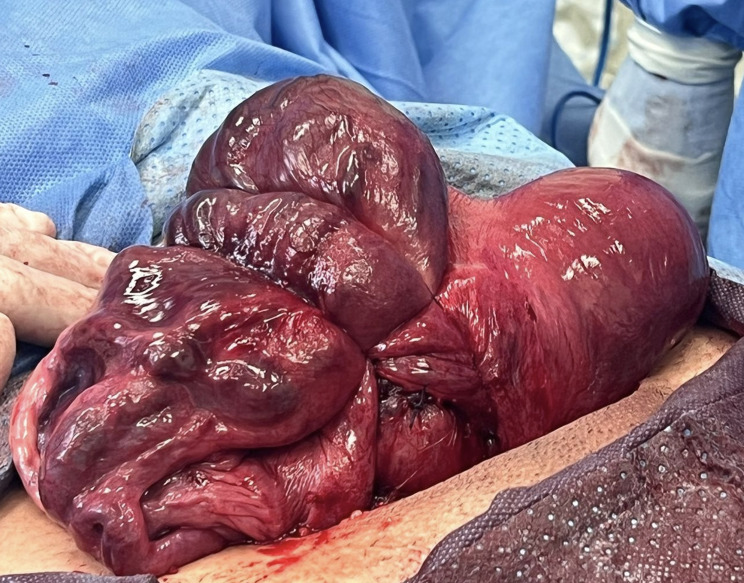 Management of postpartum hemorrhage in a patient with bicornuate uterus using the B-Lynch suture. Case report and review of the literature