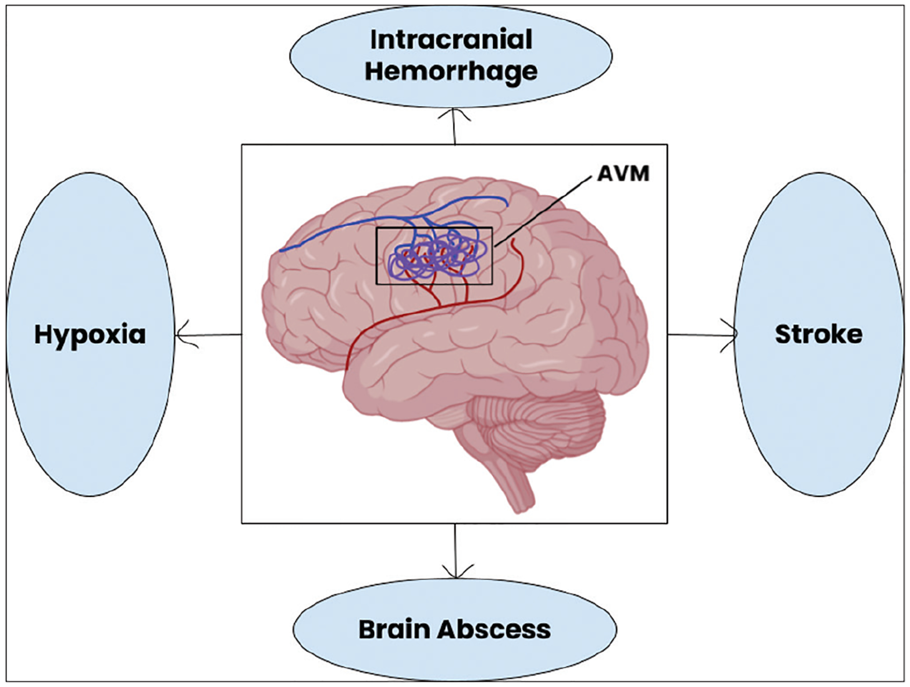 An updated review on the genetics of arteriovenous malformations.