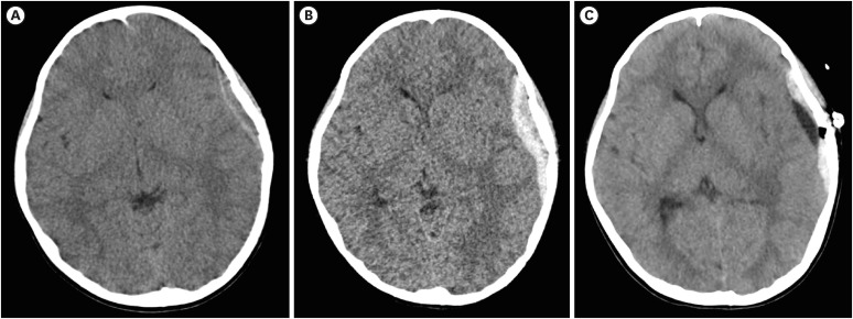 The Importance of Headgear During Scooter Riding in the Pediatric Population, and Suggesting Recommendations.