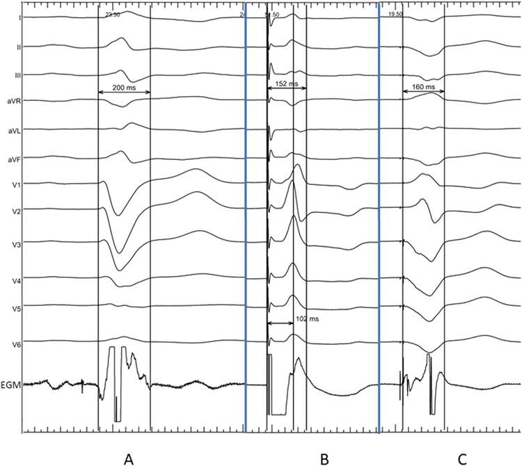 Left bundle branch area pacing results in more physiological ventricular activation than biventricular pacing in patients with left bundle branch block heart failure.