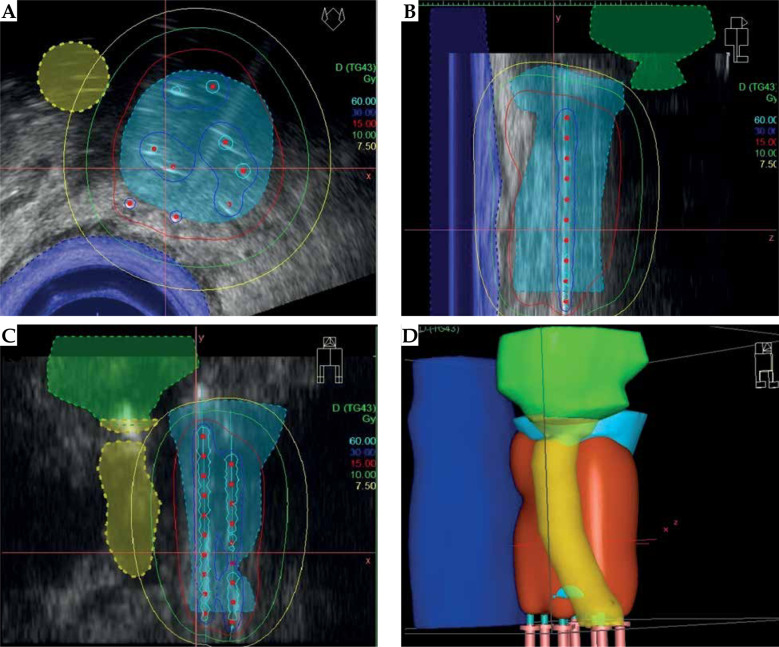 Salvage high-dose-rate interventional radiotherapy (brachytherapy) for locally relapsed prostate cancer after radical prostatectomy and subsequent external irradiation.