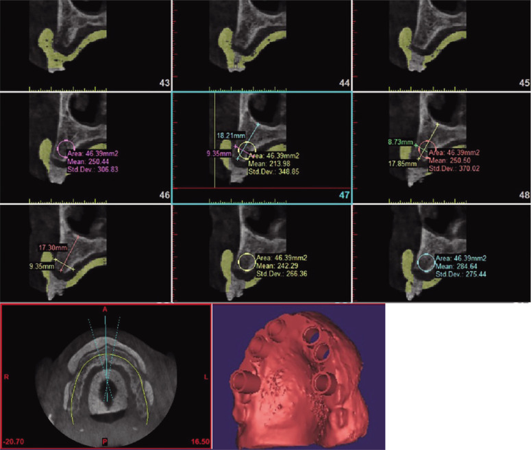 Effect of implant diameter and cantilever length on the marginal bone height changes and stability of implants supporting screw retained prostheses: A randomized double blinded control trial.