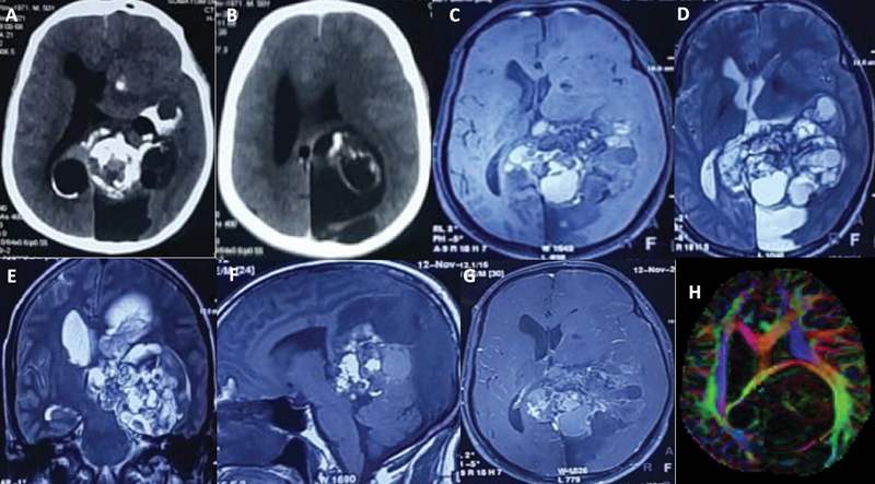 Mature Teratoma with Somatic-Type Malignancy: An Entity of Unacquaintance-A Case Report.