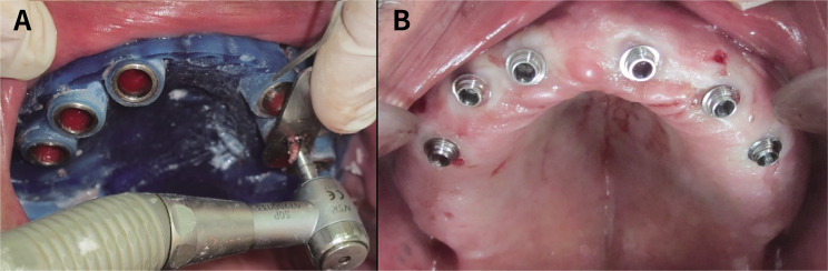 Effect of implant diameter and cantilever length on the marginal bone height changes and stability of implants supporting screw retained prostheses: A randomized double blinded control trial.