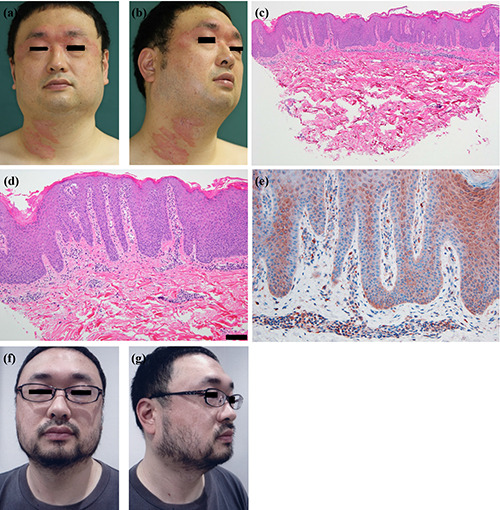 Implications of interleukin-17 in psoriatic lesions as Koebner phenomenon caused by recurrent occupational burns.