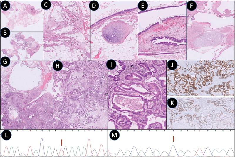 Mature Teratoma with Somatic-Type Malignancy: An Entity of Unacquaintance-A Case Report.