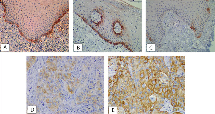 Clinical implications of Cytokeratin 19 expression in patients with oral squamous cell carcinoma.