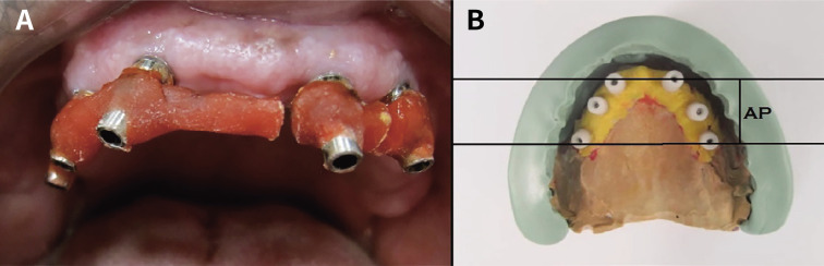 Effect of implant diameter and cantilever length on the marginal bone height changes and stability of implants supporting screw retained prostheses: A randomized double blinded control trial.