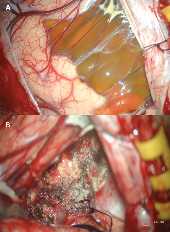 Mature Teratoma with Somatic-Type Malignancy: An Entity of Unacquaintance-A Case Report.