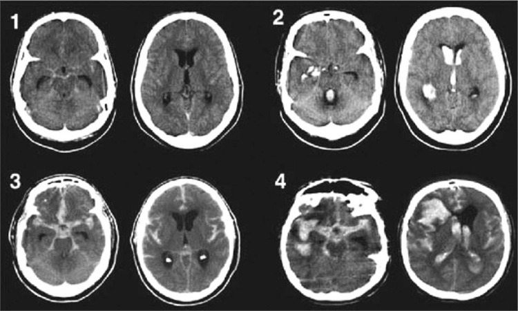 Management of Aneurysmal Subarachnoid Haemorrhage and its Complications: A Clinical Guide.