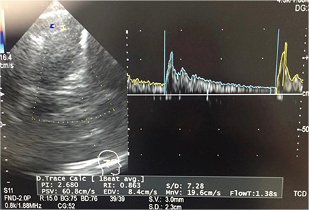 Management of Aneurysmal Subarachnoid Haemorrhage and its Complications: A Clinical Guide.