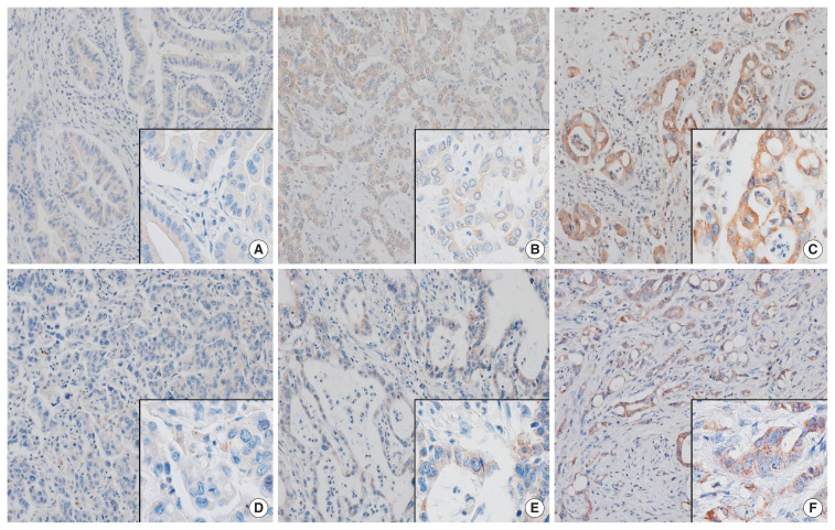 Impact of Nrf2 overexpression on cholangiocarcinoma treatment and clinical prognosis.