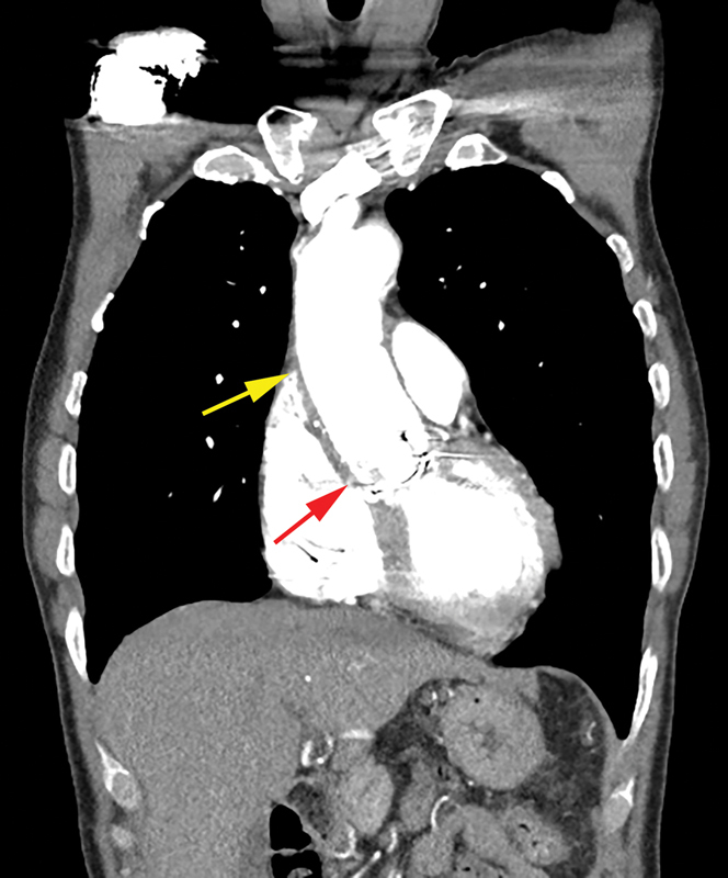 Redo Aortic Surgery in a Patient with a Large Arachnoid Cyst and Myelodysplasia.