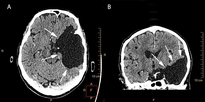 Redo Aortic Surgery in a Patient with a Large Arachnoid Cyst and Myelodysplasia.