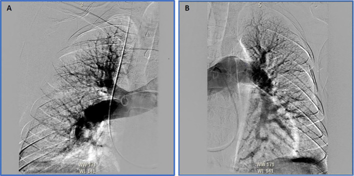 Surgical and Device Interventions in the Treatment of Chronic Thromboembolic Disease.