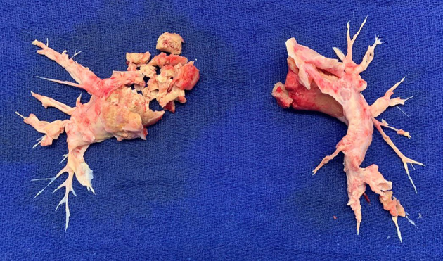 Surgical and Device Interventions in the Treatment of Chronic Thromboembolic Disease.