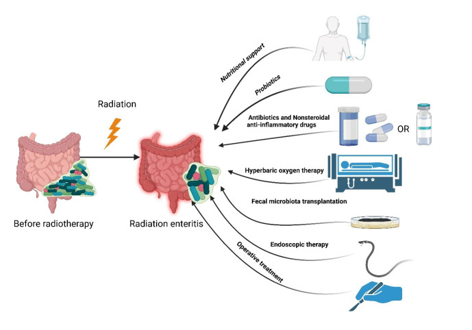 Research progress and treatment of radiation enteritis and gut microbiota.