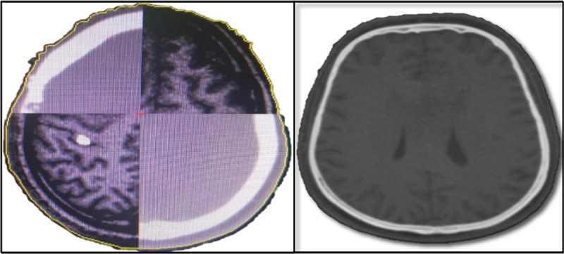 Optimizing the Radiation Treatment Planning of Brain Tumors by Integration of Functional MRI and White Matter Tractography.