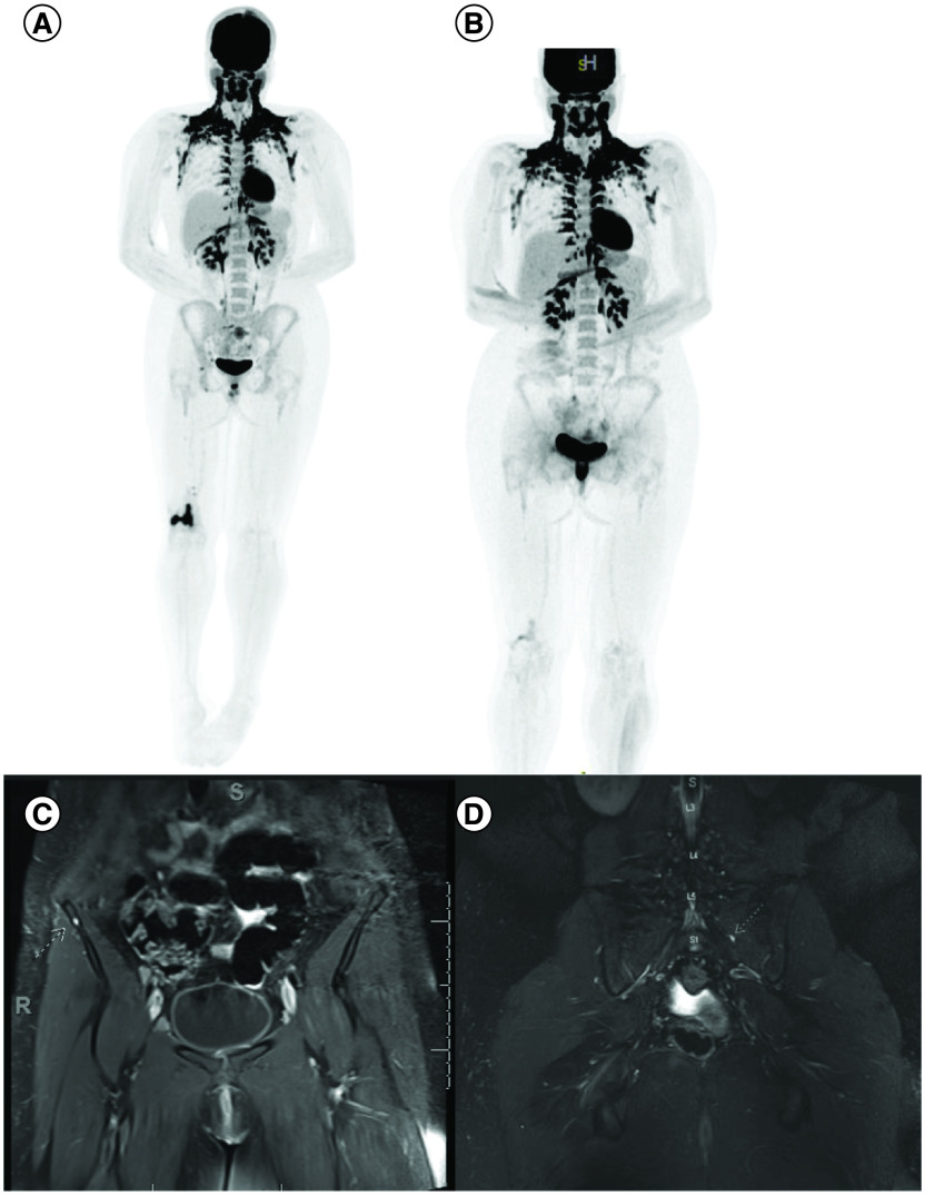 H3G34-mutant diffuse hemispheric glioma with osseous metastases: a case report and literature review.