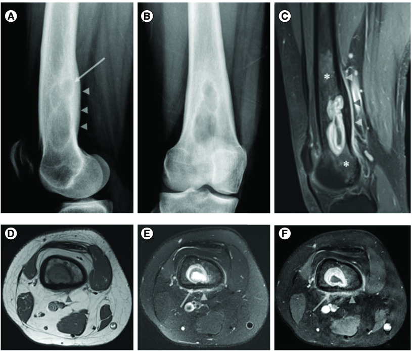 H3G34-mutant diffuse hemispheric glioma with osseous metastases: a case report and literature review.