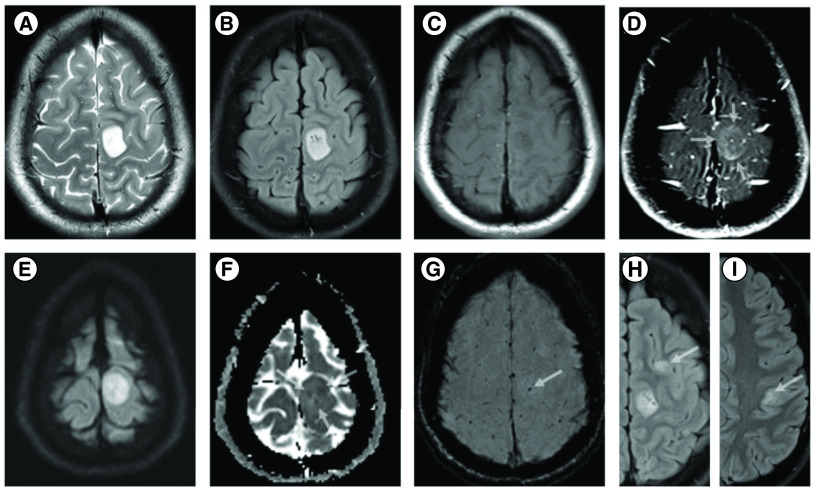 H3G34-mutant diffuse hemispheric glioma with osseous metastases: a case report and literature review.