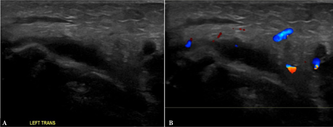 Maxillofacial inflammations visualized with ultrasonography. Description of the imaging features and literature review based on a characteristic case series.