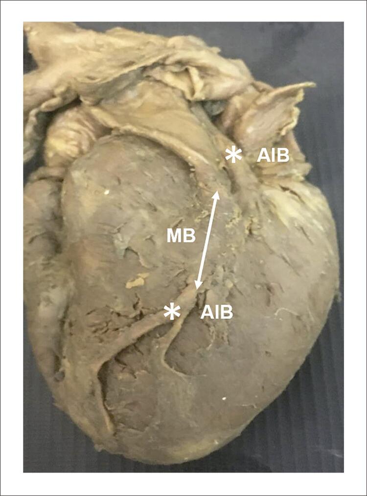 Incidence and Morphological Study of Myocardial Bridge in the State of Ceará: A Cadaveric Study.